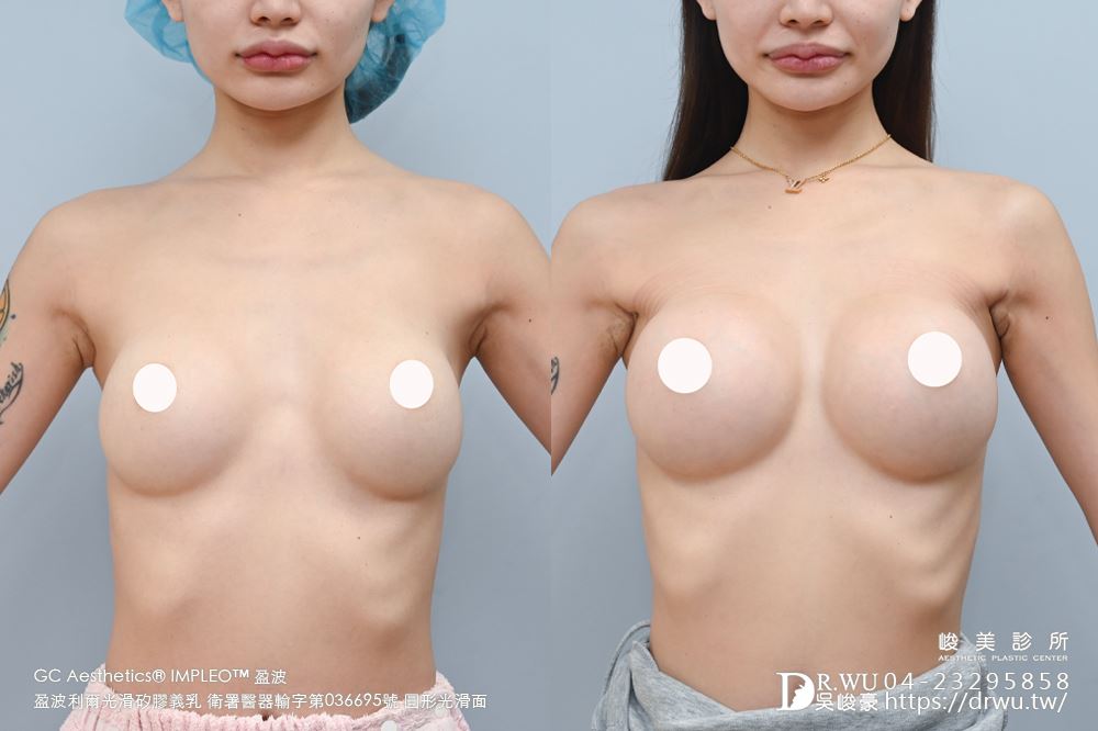 『盈波隆乳』 纖瘦女孩隆乳重修，打造飽滿芭比身材! ｜免按摩隆乳｜光滑面隆乳｜隆乳重修｜