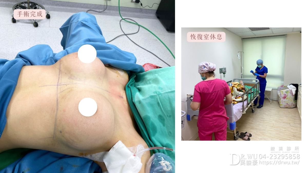 『女王波隆乳』 送自己人生大禮，峻美診所圓夢美胸 ｜女王波隆乳材質｜台中隆乳｜