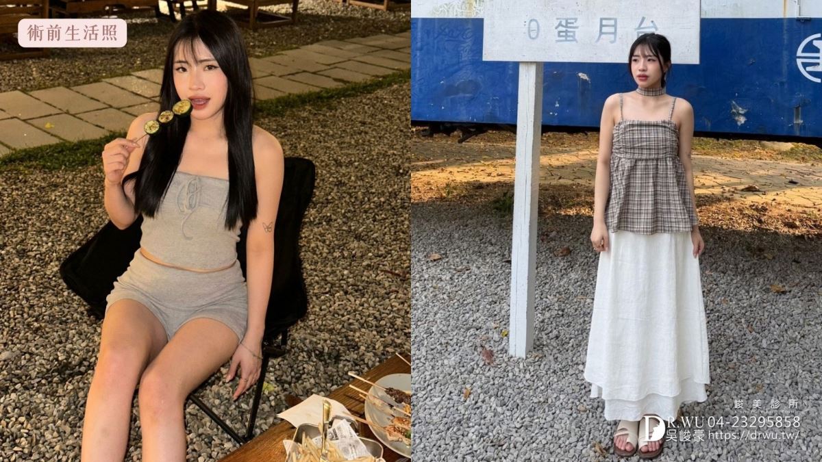『女王波隆乳』 送自己人生大禮，峻美診所圓夢美胸 ｜女王波隆乳材質｜台中隆乳｜