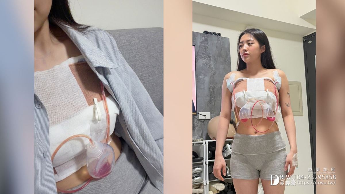 『女王波隆乳』送自己人生大禮，峻美診所圓夢美胸｜女王波隆乳材質｜台中隆乳｜