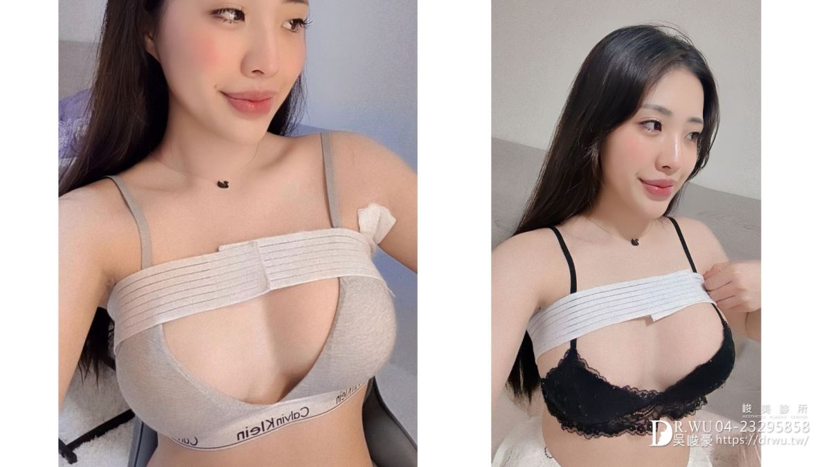 『女王波隆乳』送自己人生大禮，峻美診所圓夢美胸｜女王波隆乳材質｜台中隆乳｜