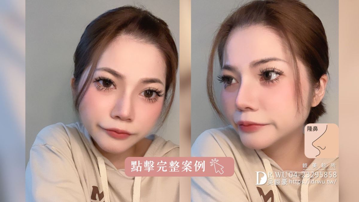 【豐額+隆鼻】肉鼻頭改善，打造微翹肋骨網美鼻！｜卡麥拉臉部植入物｜自體肋骨隆鼻｜台中隆鼻｜吳峻豪醫生｜