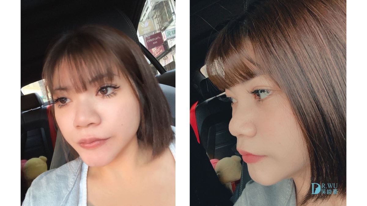 【 自體肋骨隆鼻】精緻美鼻設計，自然挺翹!｜卡麥拉臉部植入物｜台中隆鼻｜隆鼻手術