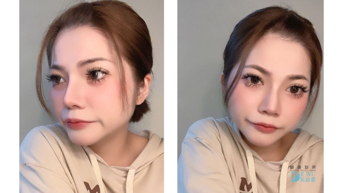 【 自體肋骨隆鼻】精緻美鼻設計，自然挺翹!｜卡麥拉臉部植入物｜台中隆鼻｜隆鼻手術