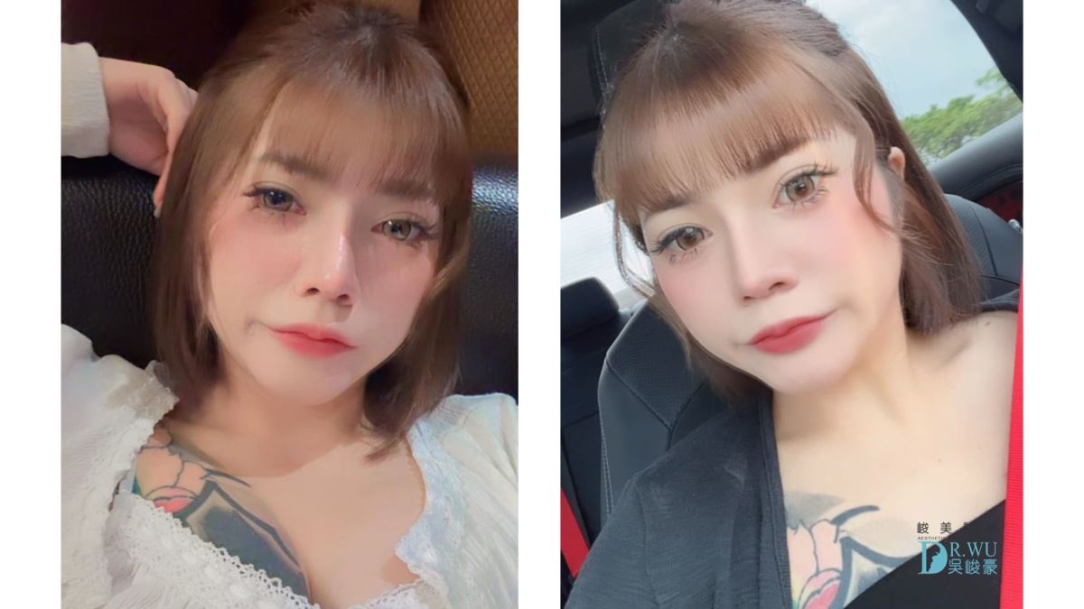 【 自體肋骨隆鼻】精緻美鼻設計，自然挺翹!｜卡麥拉臉部植入物｜台中隆鼻｜隆鼻手術