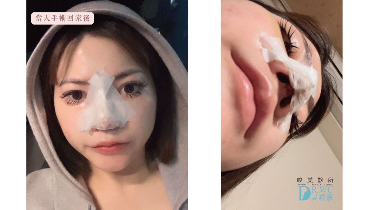 【 自體肋骨隆鼻】精緻美鼻設計，自然挺翹!｜卡麥拉臉部植入物｜台中隆鼻｜隆鼻手術