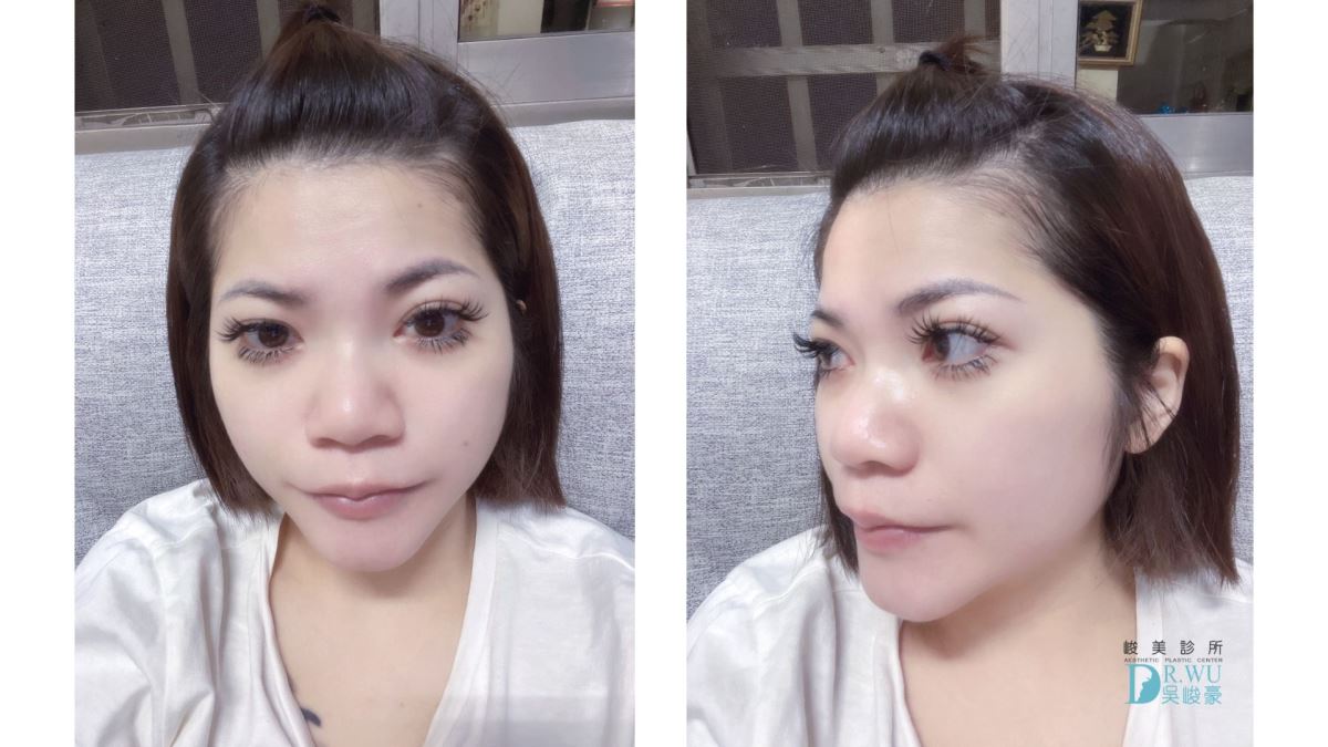 【 自體肋骨隆鼻】精緻美鼻設計，自然挺翹!｜卡麥拉臉部植入物｜台中隆鼻｜隆鼻手術