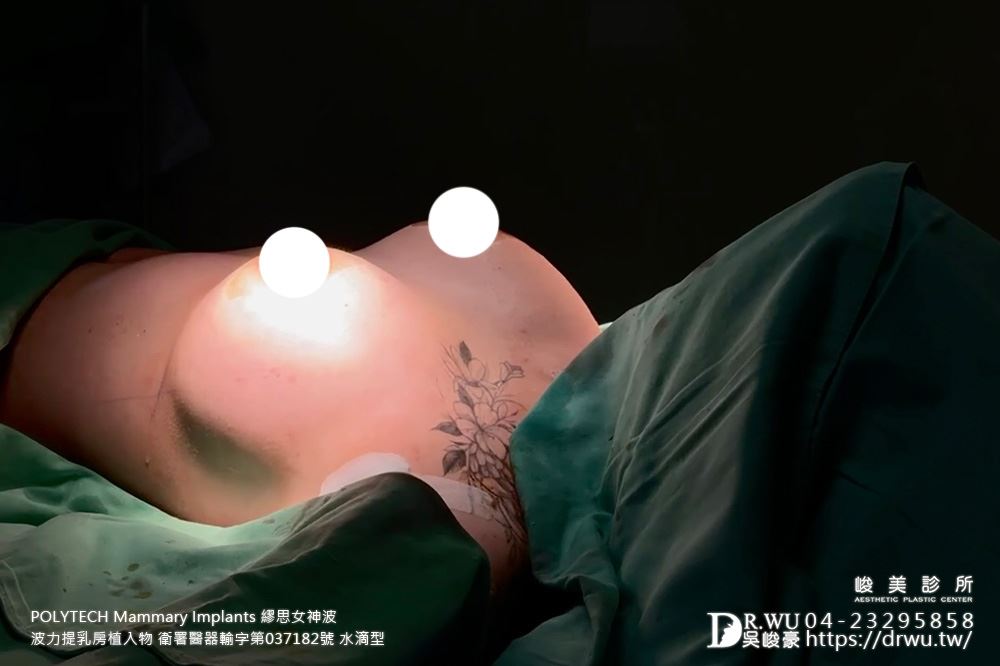 『繆思女神波隆乳』 產後哺乳萎縮，女神波還我自然美胸! ｜產後萎縮 ｜水滴型｜台中隆乳｜女神波｜