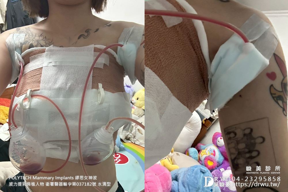 『繆思女神波隆乳』 產後哺乳萎縮，女神波還我自然美胸! ｜產後萎縮 ｜水滴型｜台中隆乳｜女神波｜